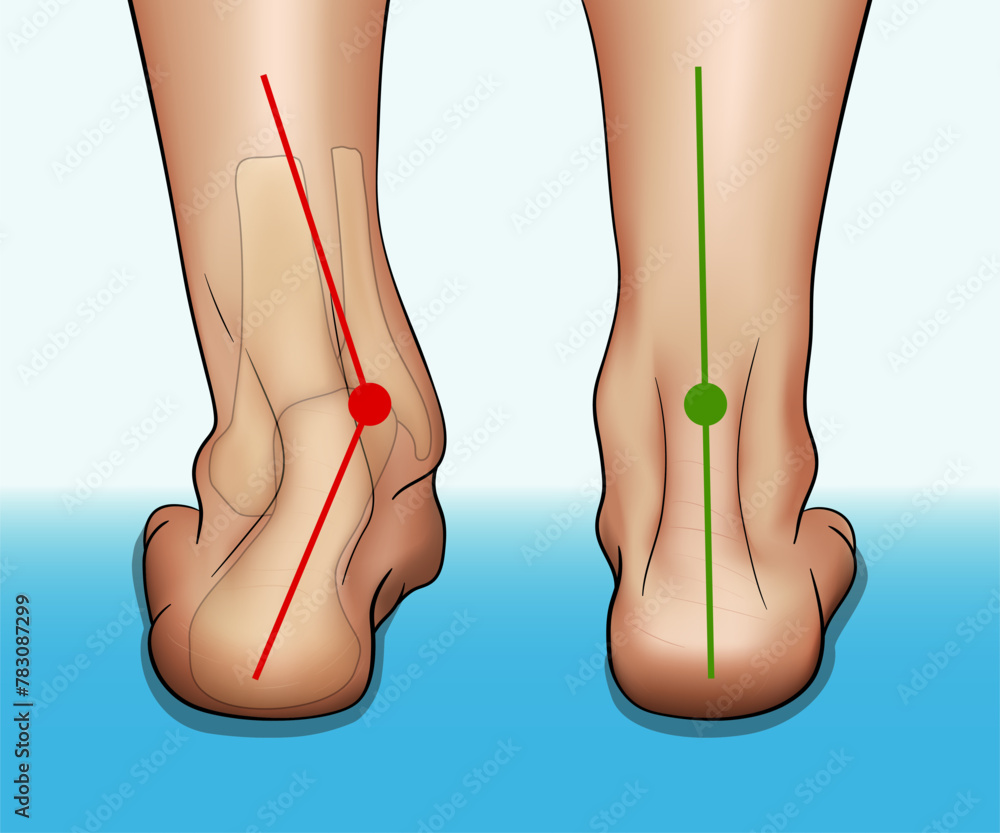 BÀN CHÂN BẸT KHI NÀO CẦN CAN THIỆP?