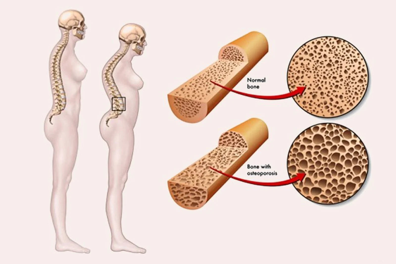 Top 7 căn bệnh xương khớp phổ biến ở người Việt Nam