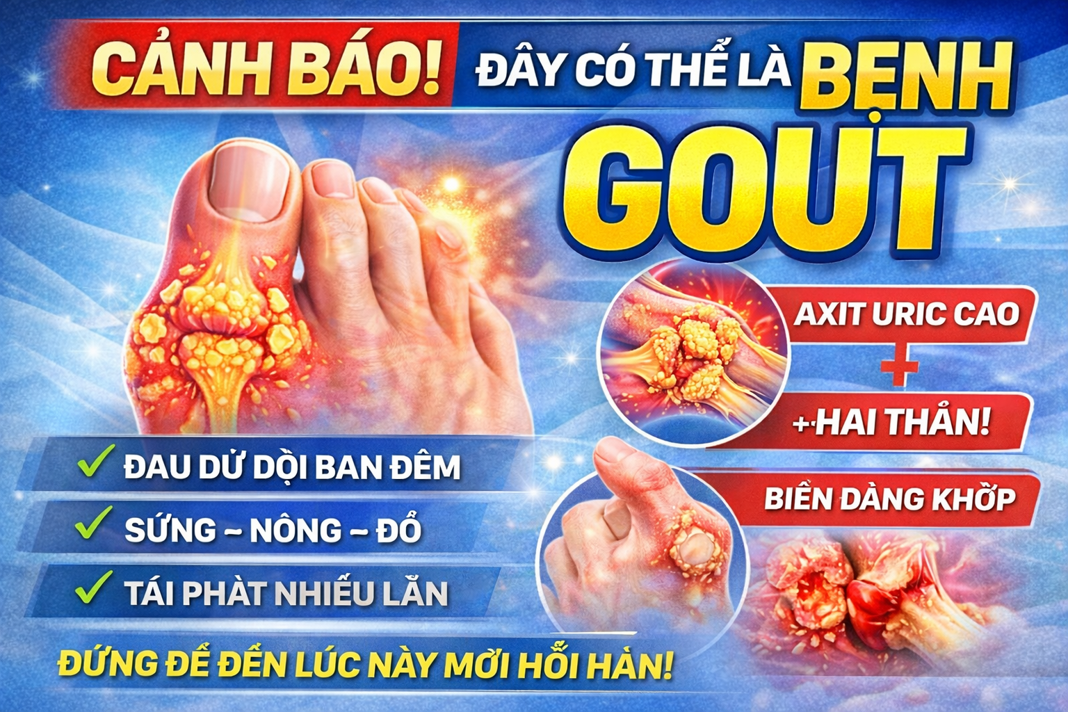 NGUYÊN NHÂN- TRIỆU CHỨNG VÀ ĐIỀU TRỊ BỆNH GOUTE