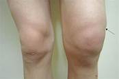 TRÀN DỊCH KHỚP GỐI. NGUYÊN NHÂN, TRIỆU CHỨNG, ĐIỀU TRỊ