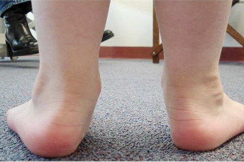 TÁC HẠI CHỦA BÀN CHÂN BẸT